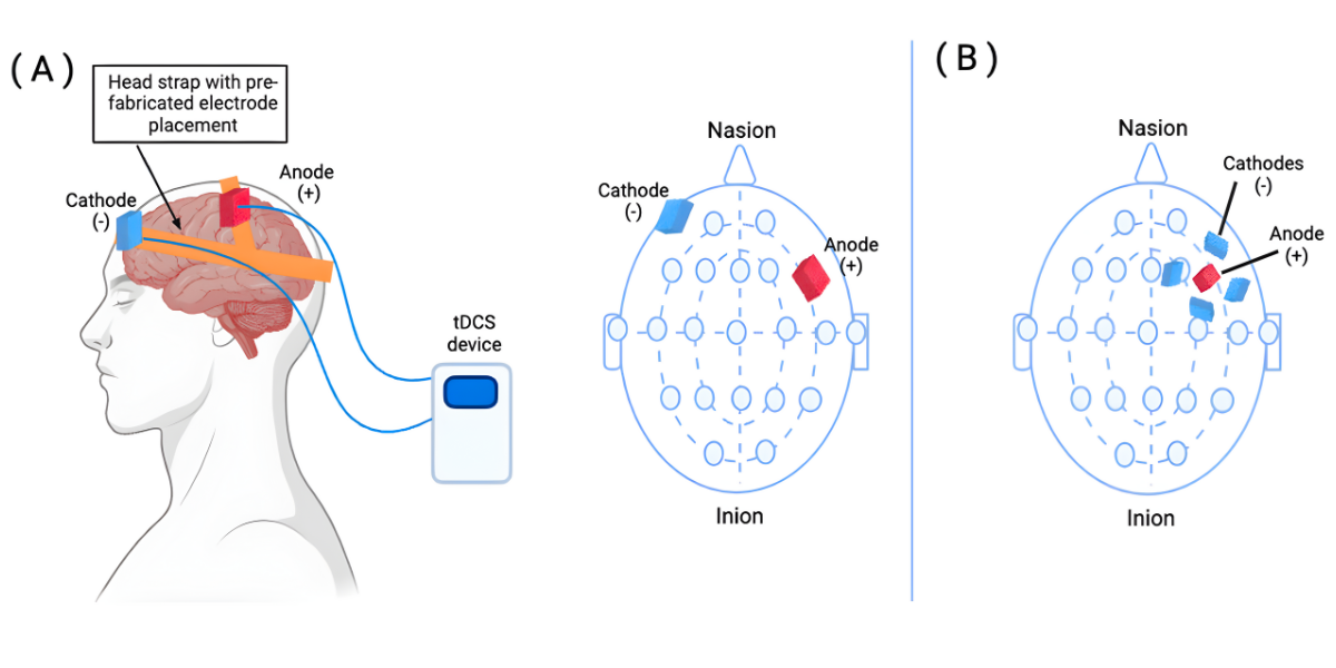 tDCS Karimnagar,brain stimulation therapy Karimnagar,non invasive brain therapy Telangana,depression treatment Karimnagar,anxiety treatment Karimnagar,neuromodulation therapy Karimnagar,Dr L Versi Psychiatrist,Suma Hospital Mental Health,brain stimulation Telangana,cognitive enhancement therapy